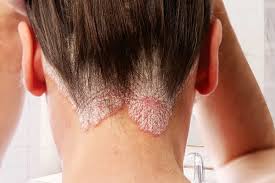best psoriasis shampoo australia