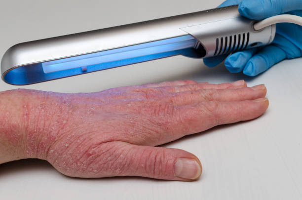 How Effective is UVB
