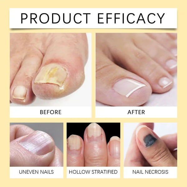 Bee Venom Nail Solution Efficiency