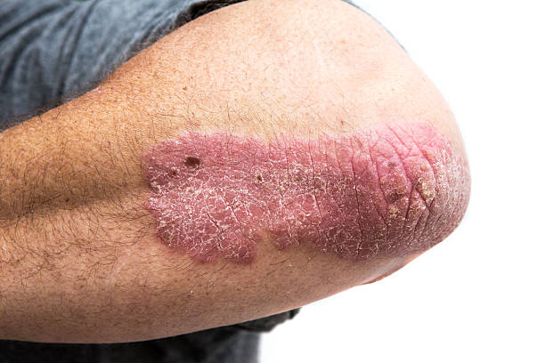 psoriasis skin