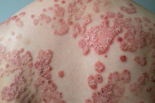 Hyaluronic Acid for Psoriasis Australia