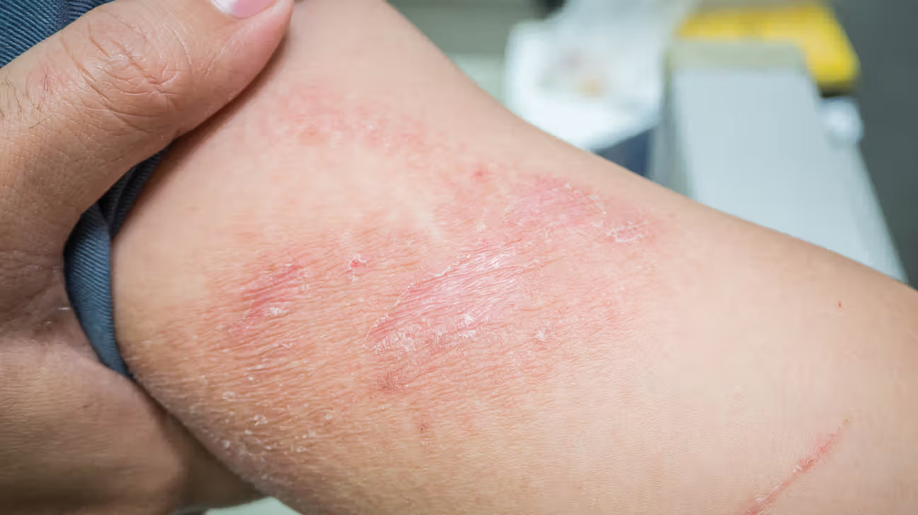 Allergic Contact Dermatitis