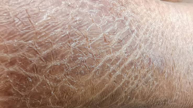 Asteatotic eczema
