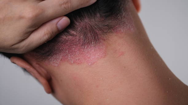 Best Shampoo for Plaque Psoriasis on Scalp