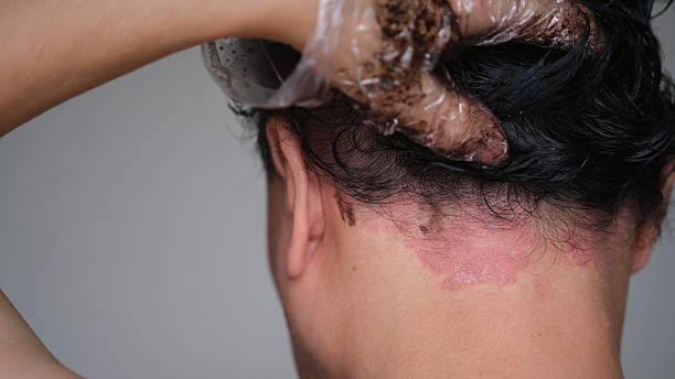 Best Tar Shampoo for Psoriasis