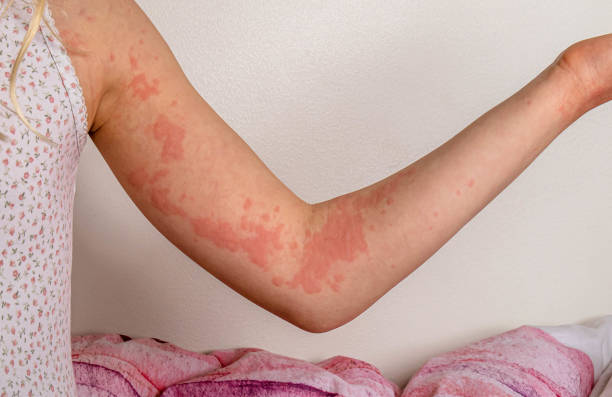 Contact Urticaria Australia