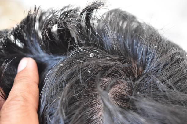 Coal Tar vs Ketoconazole Shampoo Australia