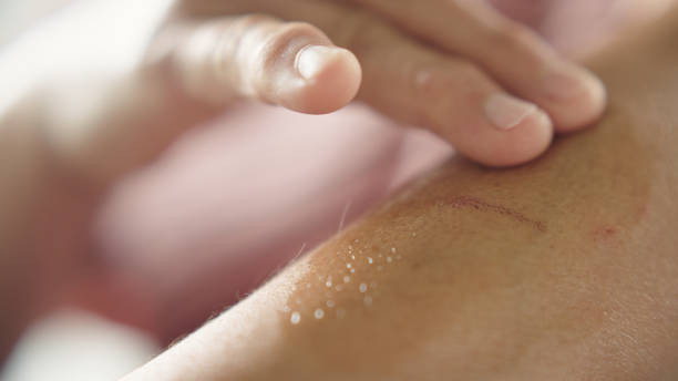 Damaged Skin Barrier Australia