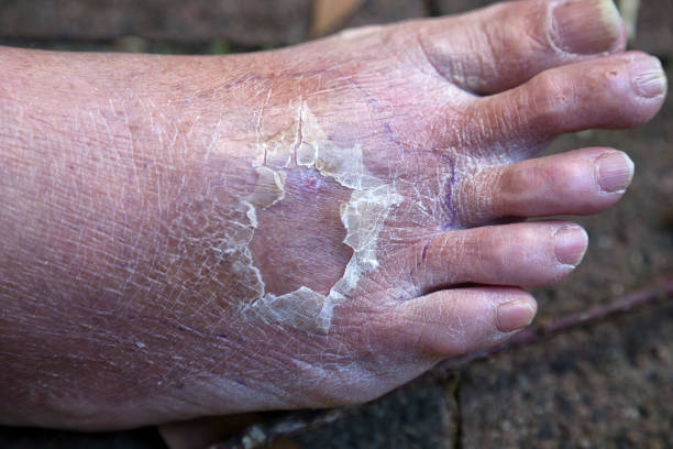 Dyshidrotic Eczema Australia