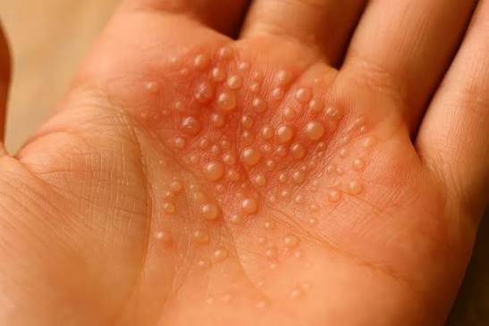 Dyshidrotic Eczema Treatment Australia