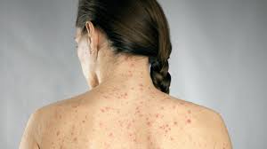 Eczema Acne