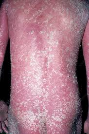Erythrodermic Psoriasis Australia