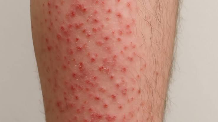 Follicular Eczema