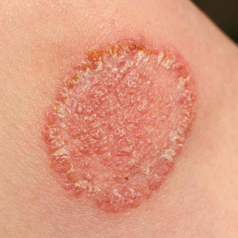 Fungal Skin Infection Australia