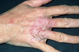 Does Diet affect Eczema