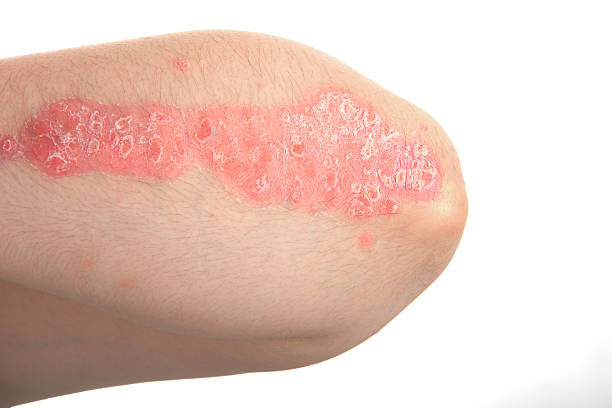 How Long Do Psoriasis Flare-Ups Last