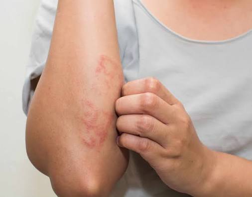 Hyaluronic Acid for Eczema Australia