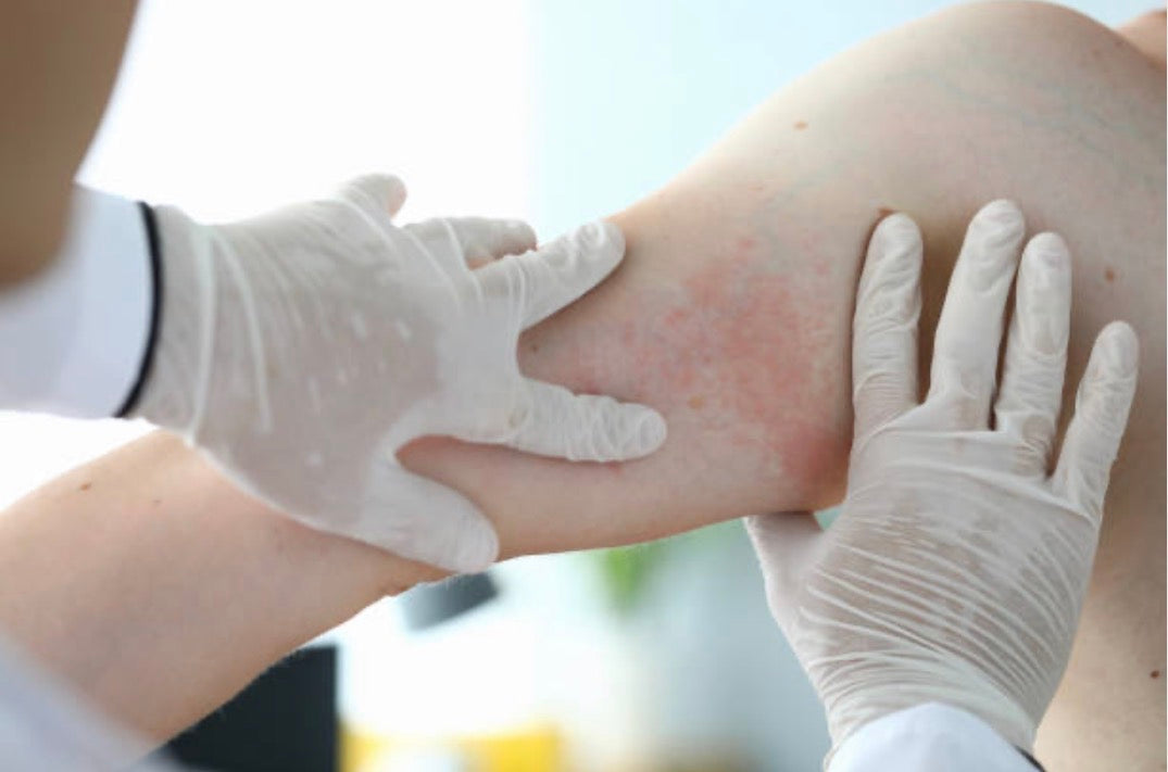 What to Do If Your Skin Reacts to a New Product Australia