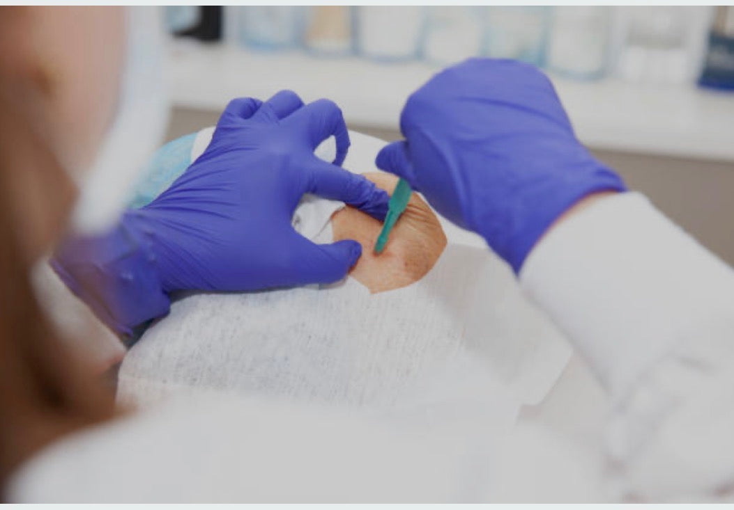 What Happens During a Skin Biopsy Australia