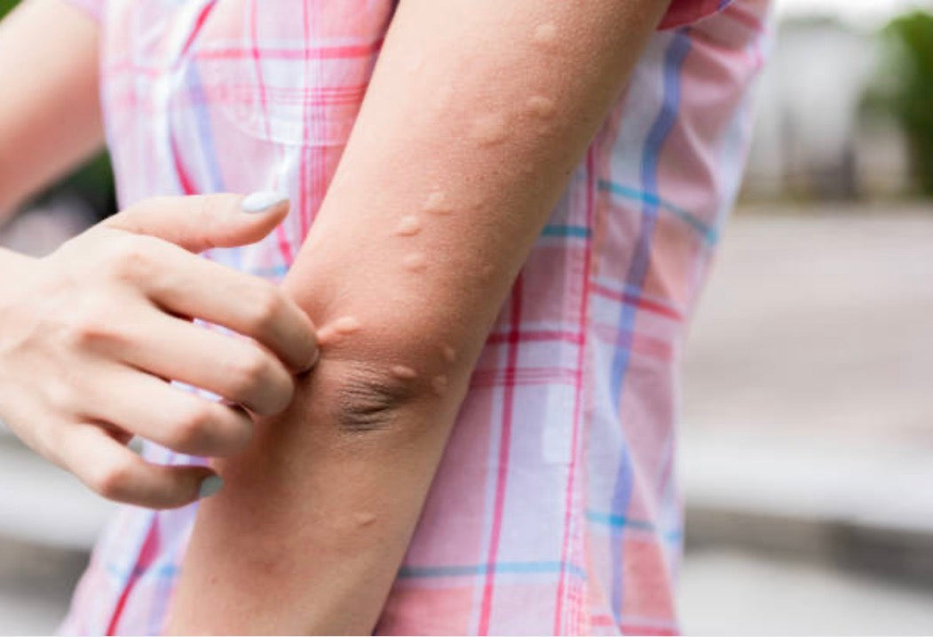 Hives Australia