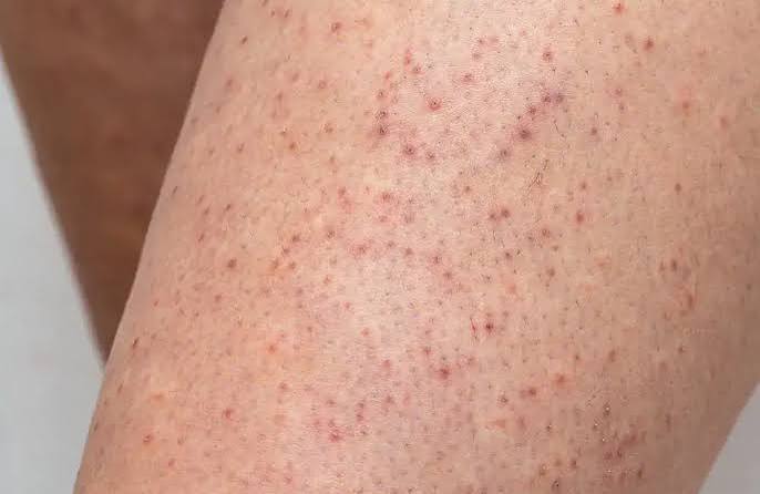 Urea for Keratosis Pilaris Australia