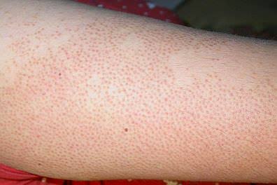 Keratosis Pilaris in Children Australia