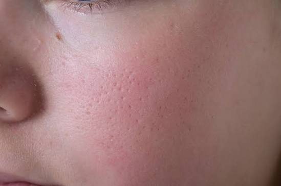Keratosis Pilaris on Face Australia