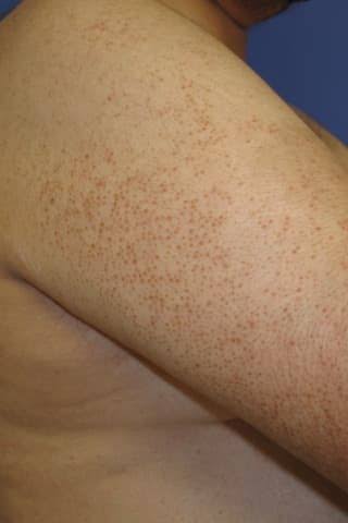 Does Keratosis Pilaris Go Away Australia