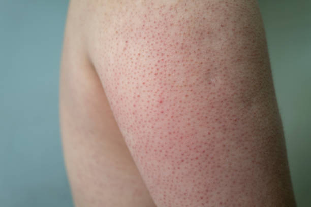 Keratosis Pilaris Australia