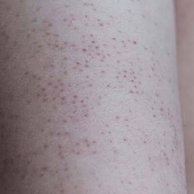 Keratosis Pilaris Diet Australia
