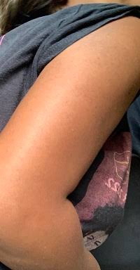 Keratosis Pilaris on Thighs Australia