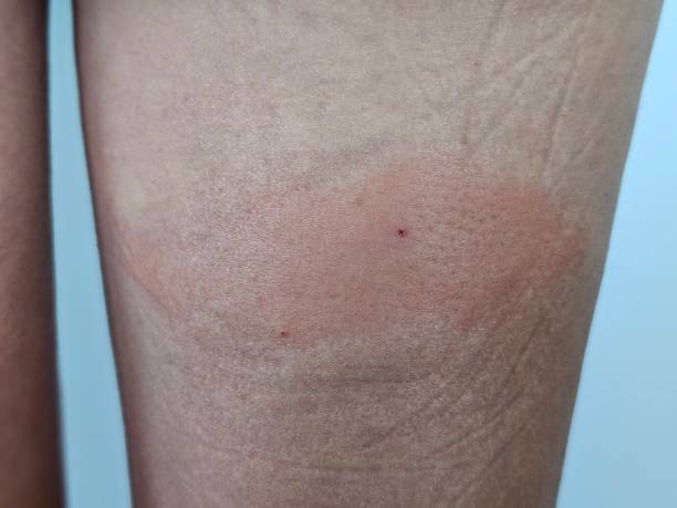 What Is a Minimal Erythema Dose (MED)