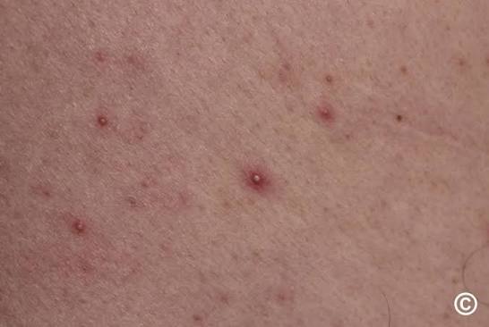 Malassezia Folliculitis Australia