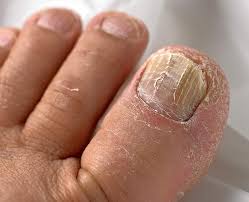 Nail Fungus Australia