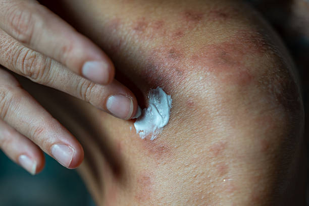 Niacinamide for Eczema