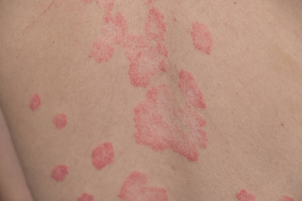 Niacinamide for Psoriasis Australia