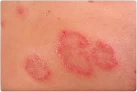 Nummular Eczema Australia