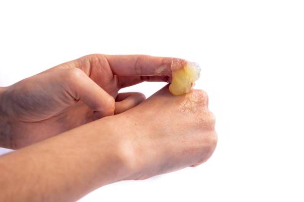 Petrolatum for Psoriasis Australia