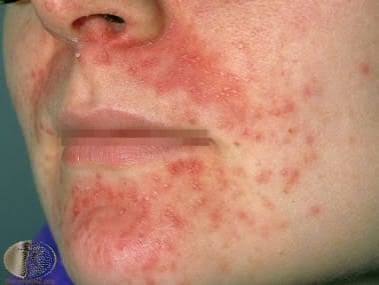Perioral Dermatitis