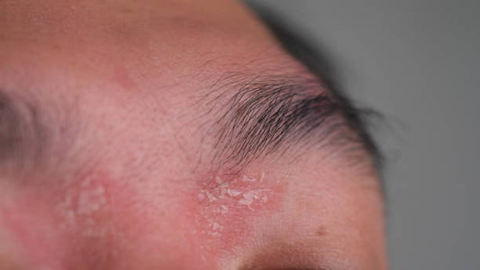 Psoriasis Symptoms