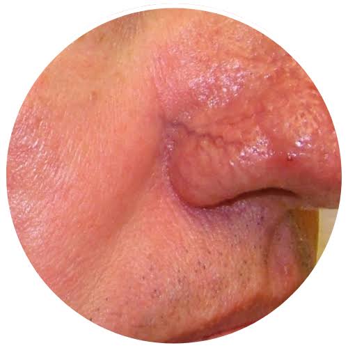 Rosacea on Nose Australia
