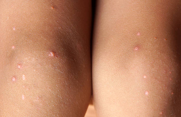 Salicylic Acid for Folliculitis Australia