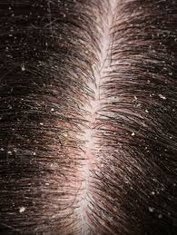 Seborrheic Dermatitis Scalp Treatment Australia