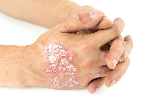 Topical Treatments for Psoriasis