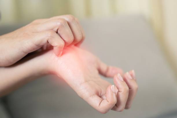 uv light therapy for eczema