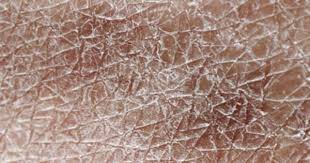 Xerosis Australia