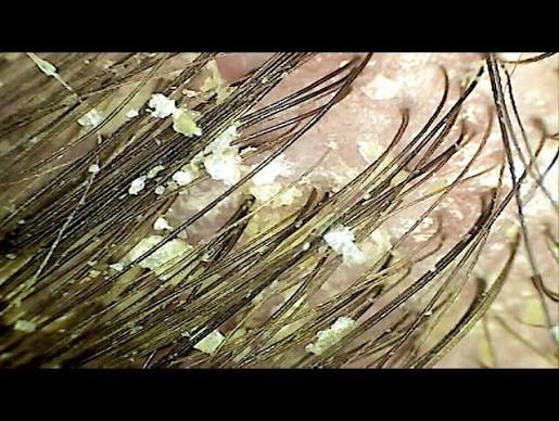 Can Adults Get Cradle Cap in Australia