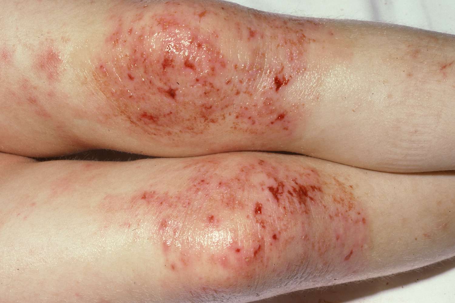 Eczema in Adults Australia