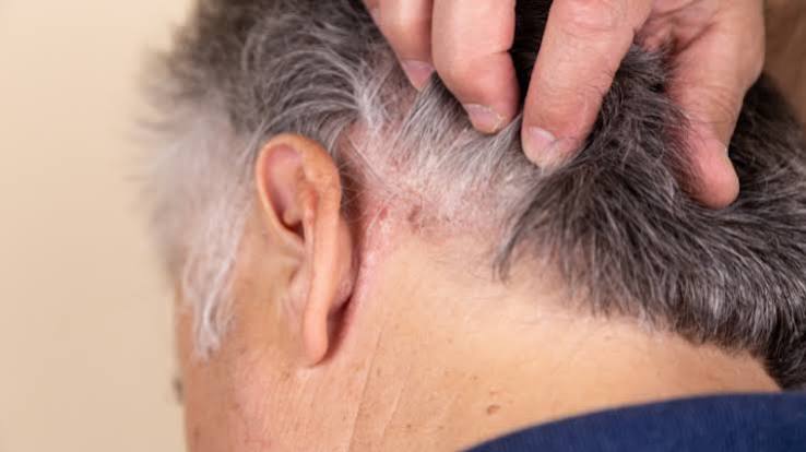 Scalp Care Routine for Older Adults Australia