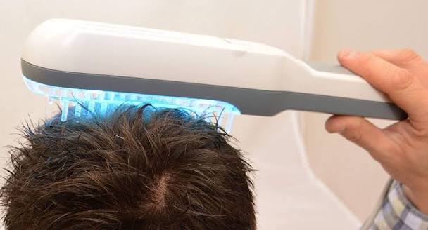 UVB Light Therapy for Alopecia